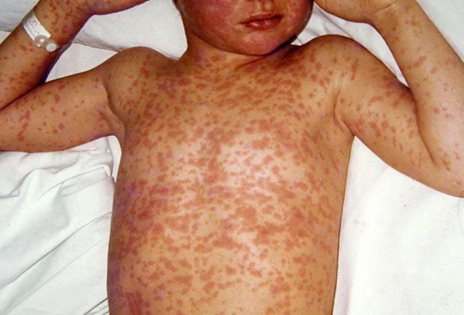 Ruam yang ditimbulkan akibat infeksi Measles (Campak).