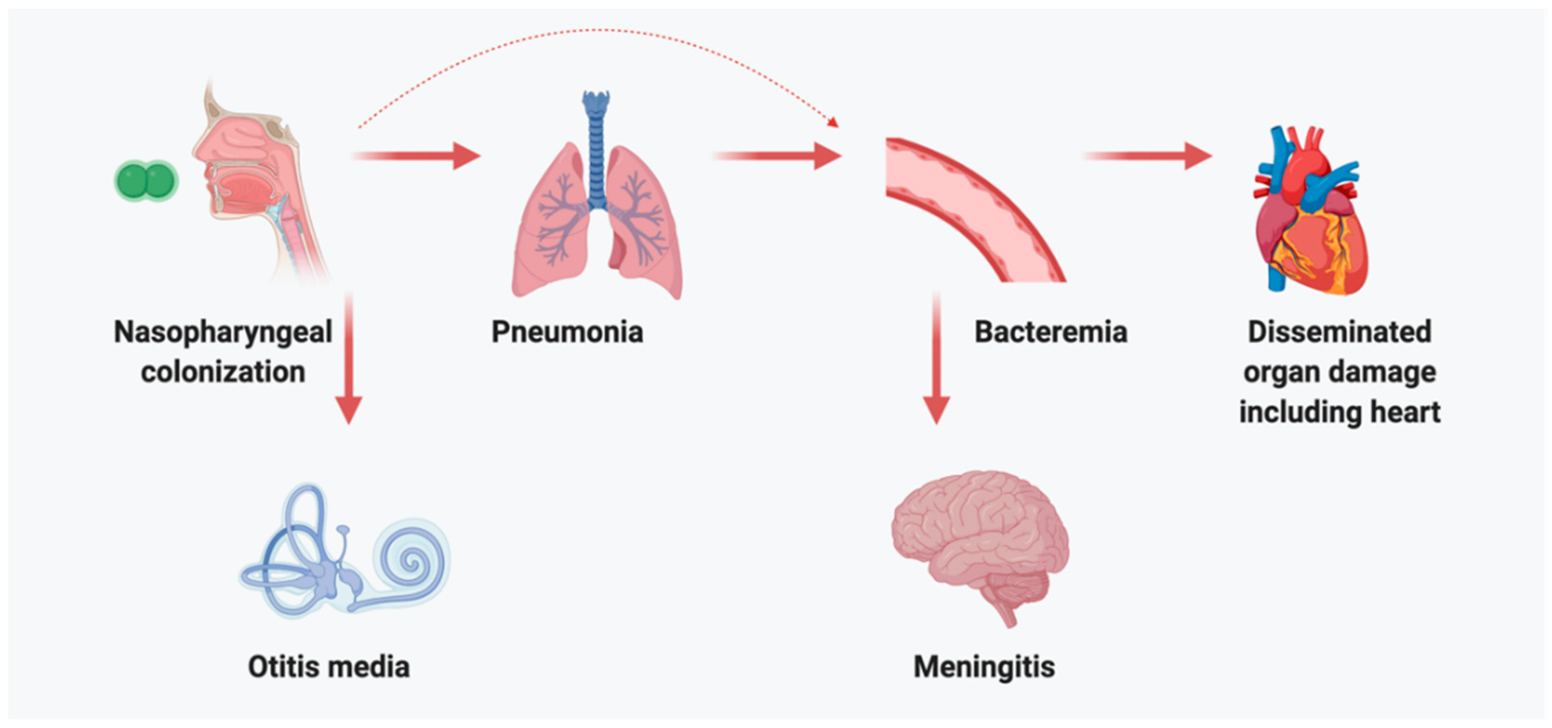 Bakteri Pneumonia masuk melalui saluran pernapasan dan dapat menginfeksi organ vital lainnya.