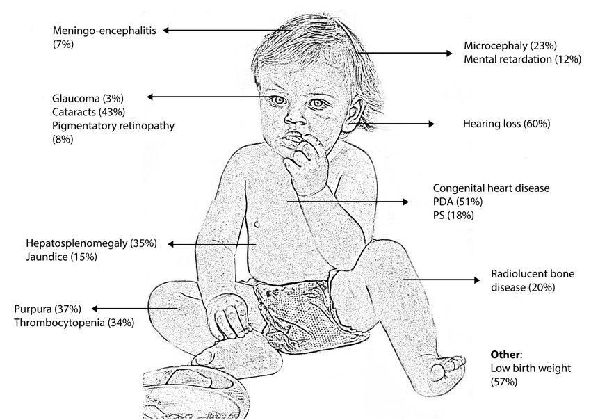 Congenital Rubella Syndrome pada bayi dapat mengakibatkan beberapa kelainan bawaan.