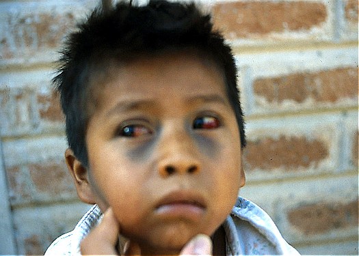 Anak dengan perdarahan dan memar di bawah mata akibat batuk keras karena infeksi Pertusis