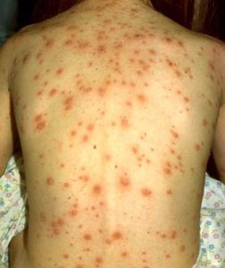 Infeksi Varicella yang terjadi pada orang yang tidak melakukan vaksinasi