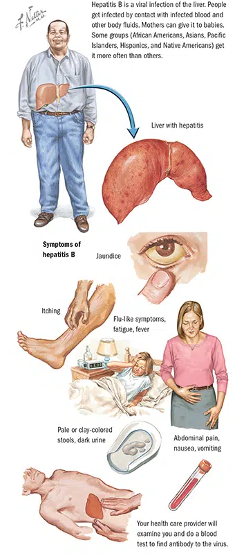 Gejala infeksi Hepatitis B