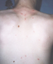 Infeksi Varicella yang terjadi pada orang yang melakukan vaksinasi