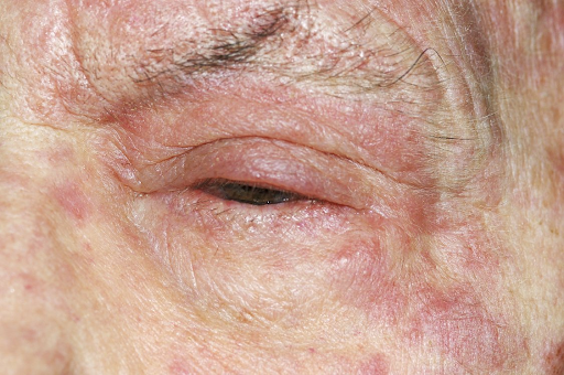 Gambar 3. Lesi herpes zoster (predileksi lesi di mata)