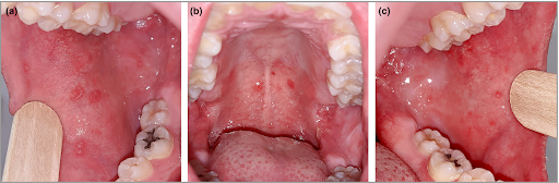 Gambar 1. Bercak putih kecil di dalam mulut (Koplik’s spot)